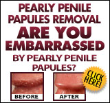The Pearly Penile Papules Removal is an effective program that promises you results if you follow the instructions properly. If you are looking for an affordable and natural way of getting rid of your pearly penile papules, then the Pearly Penile Papules Removal is the perfect product for you. Not only will it remove pearly penile papules, but it will also improve your sex life and boost your self-confidence once and for all. 